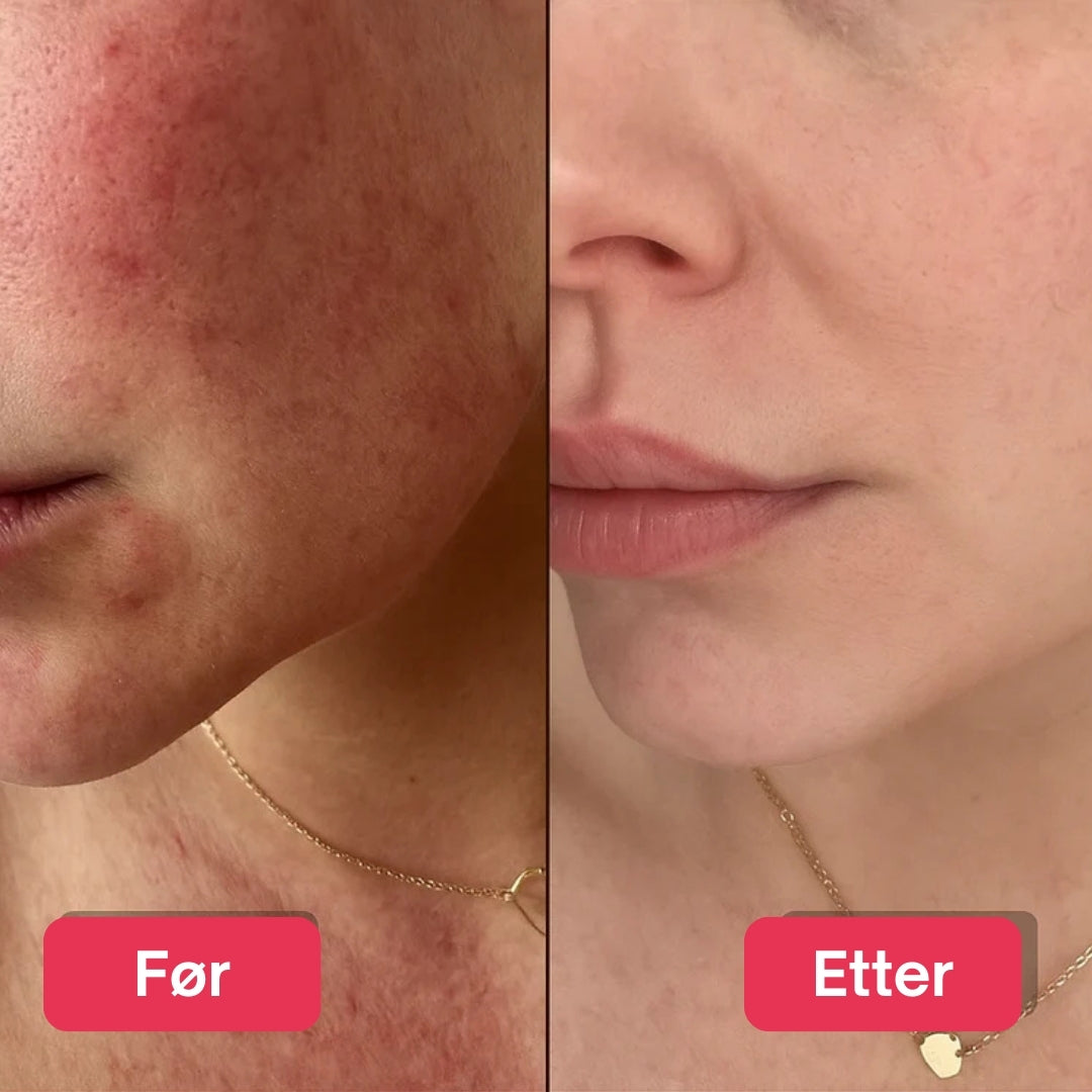 LED Lysterapi Ansiktsmaske