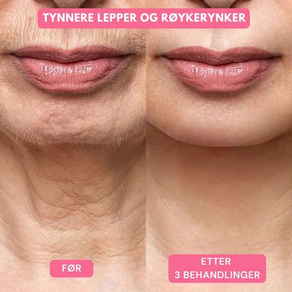Lunaria Micro-Infusion Behandling